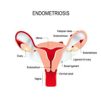 Endometriosis Diagram