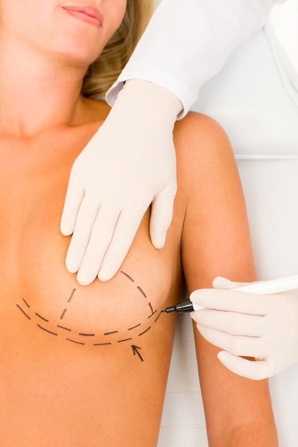 breast augmentation