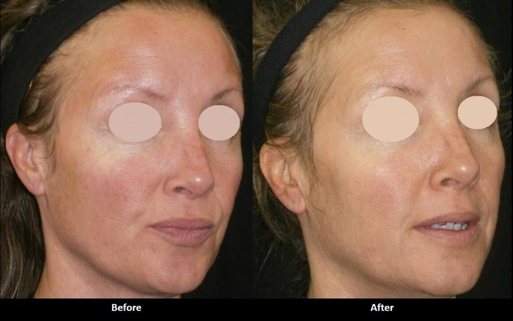 Forever Young BBL IPL photofacial before and after