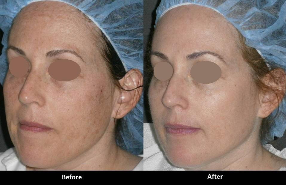 Forever Young BBL IPL photofacial before and after