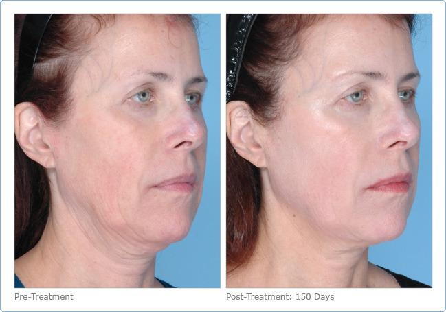 Ultherapy before and after face