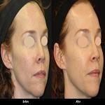 A E Skin Soft and Smooth Rejuvenation before and after