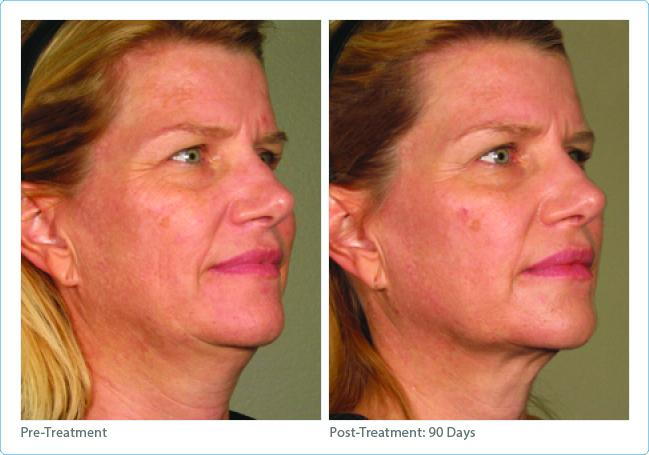 Ultherapy before and after face