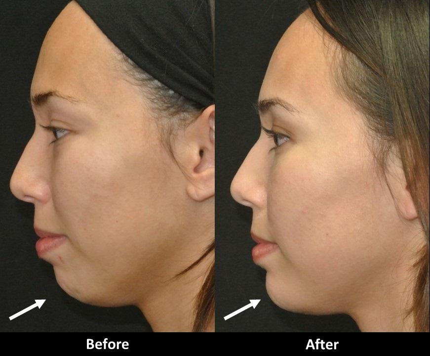 Voluma chin before and after