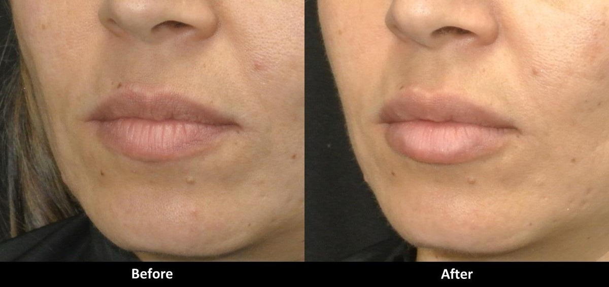 Vollure before and after lips