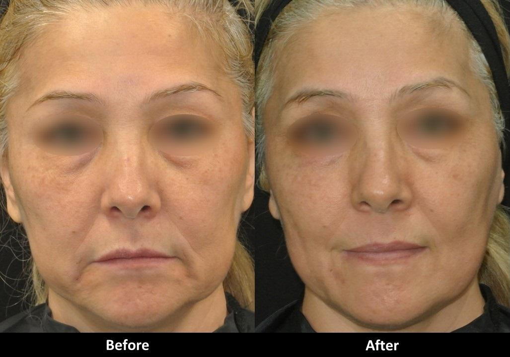 Ultra Microneedling before and after