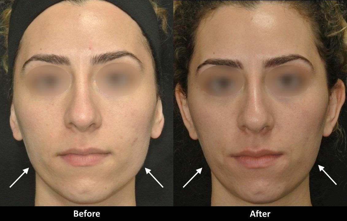 Botox to contour the lower face