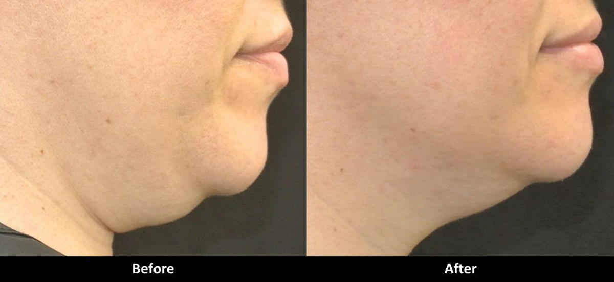 Laser Skin Tightening Before and After