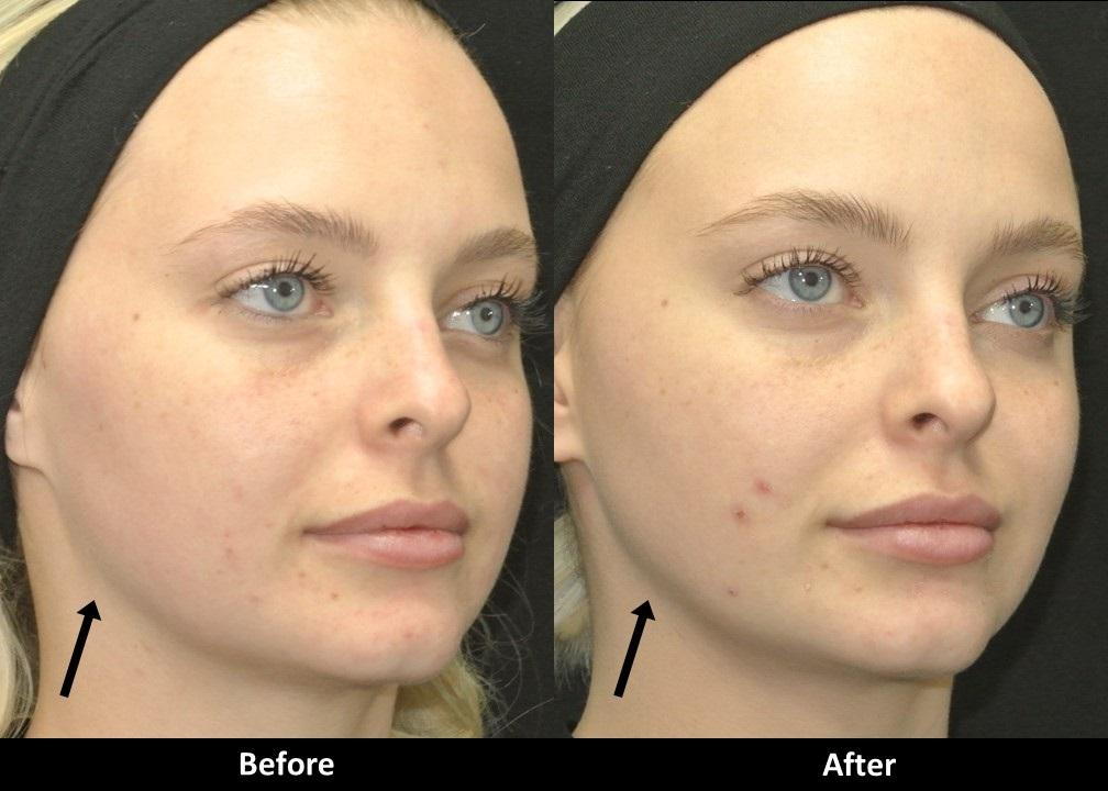 Laser Skin Tightening Before and After