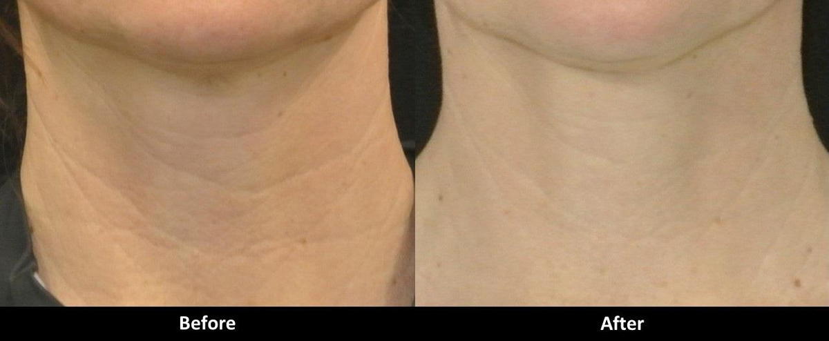 Laser Skin Tightening Before and After