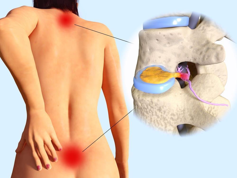 Diagram shows herniated discs after a car accident