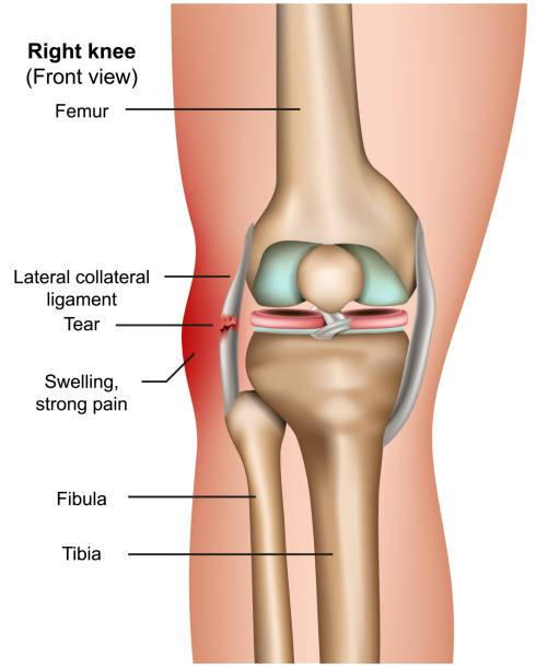 Medical Illustration of a knee ligament tear
