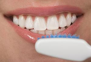 Dental Veneers