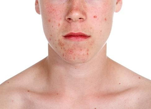 Teenage Acne