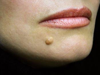 Facial Mole Removal Success Story   Cosmedics Skin Clinics