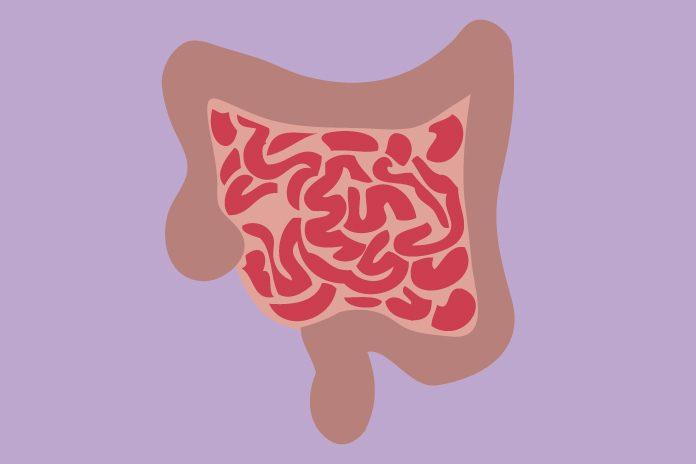 Ulcerative Colitis Condition  Gastroenterology of Greater Orlando