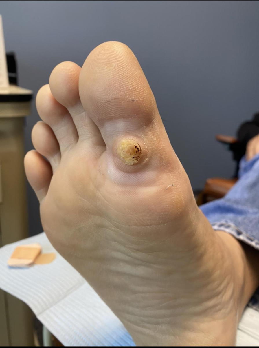 Yellow or White Bumps on Feet | Common Causes & Relief Options