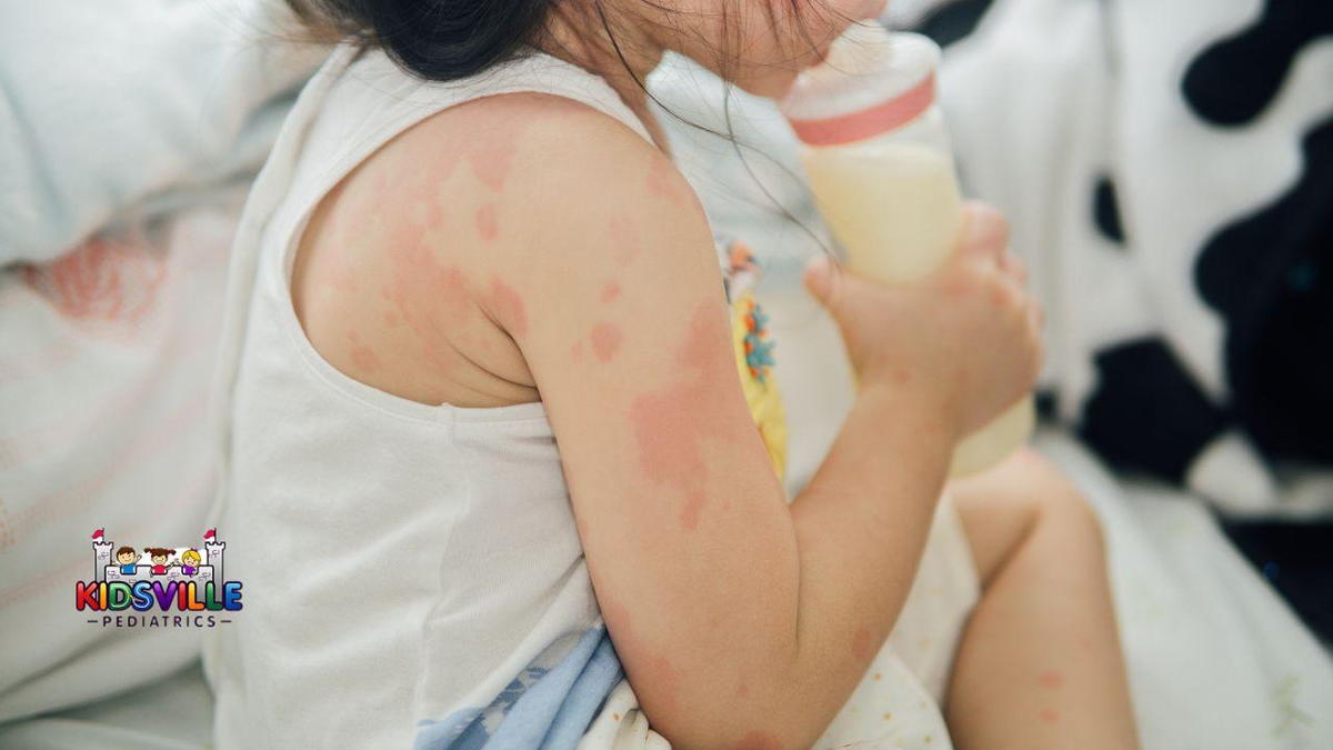 A young girl showing a rash on her arm as she drinks from her bottle of milk.