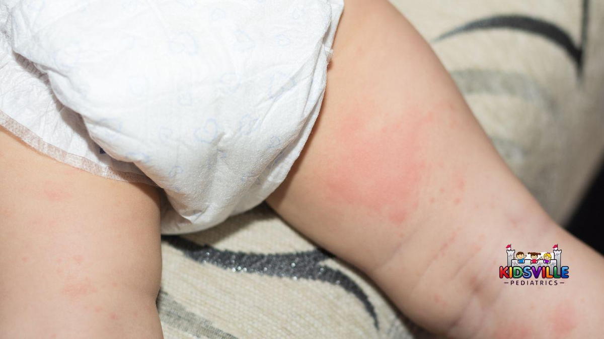 Thighs of baby showing diaper rash.