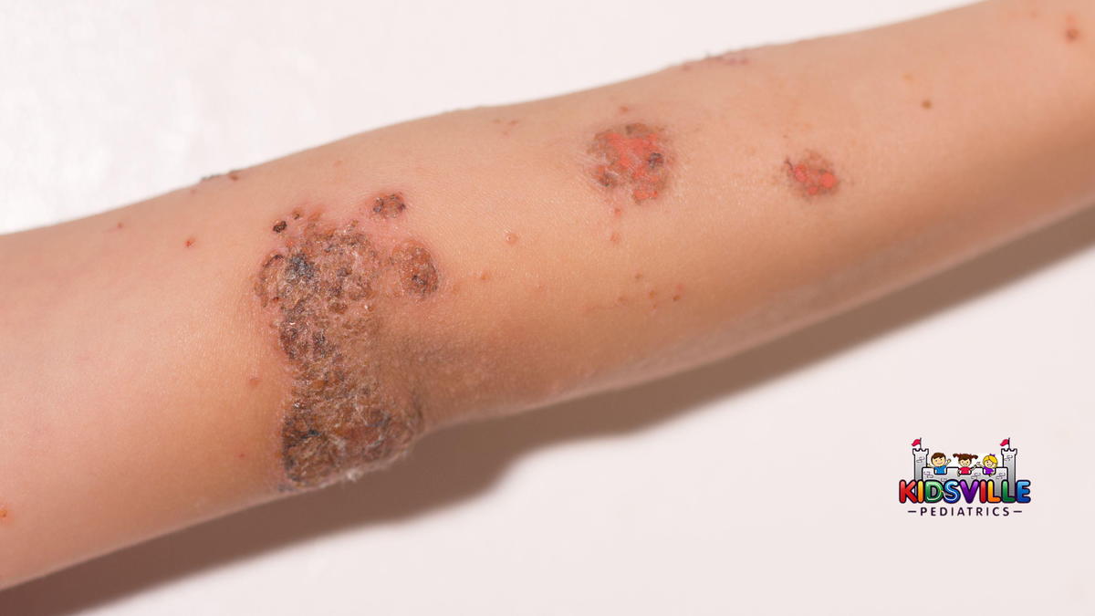 Child's Arm With Impetigo.