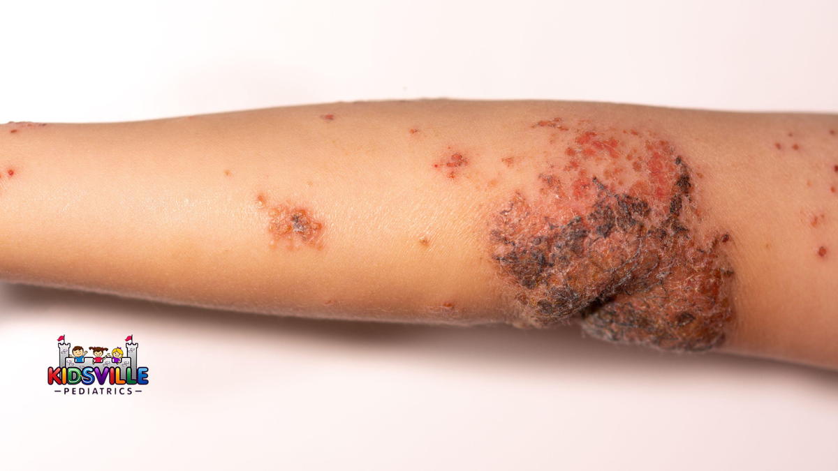 Child with Impetigo on the arm.