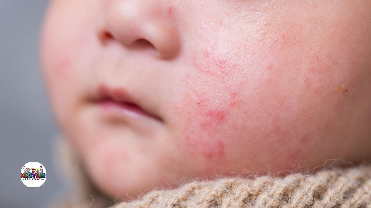 Baby cheeks with visible eczema and rash