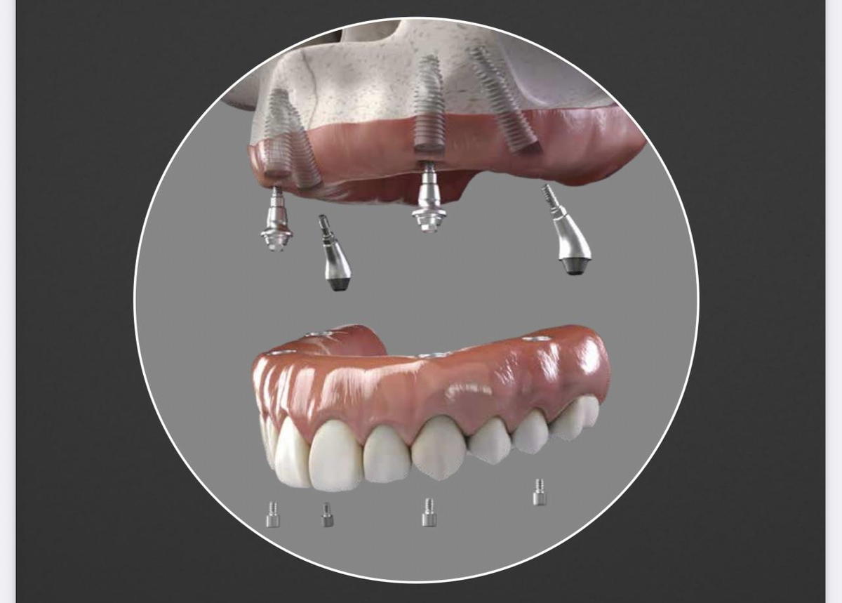 dental implants fort lauderdale florida