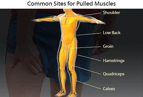 Muscle strain is another name for a pulled muscle.
