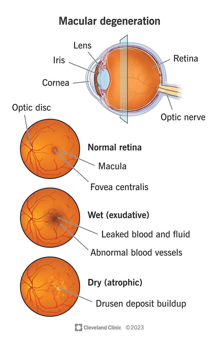 Macular Degeneration