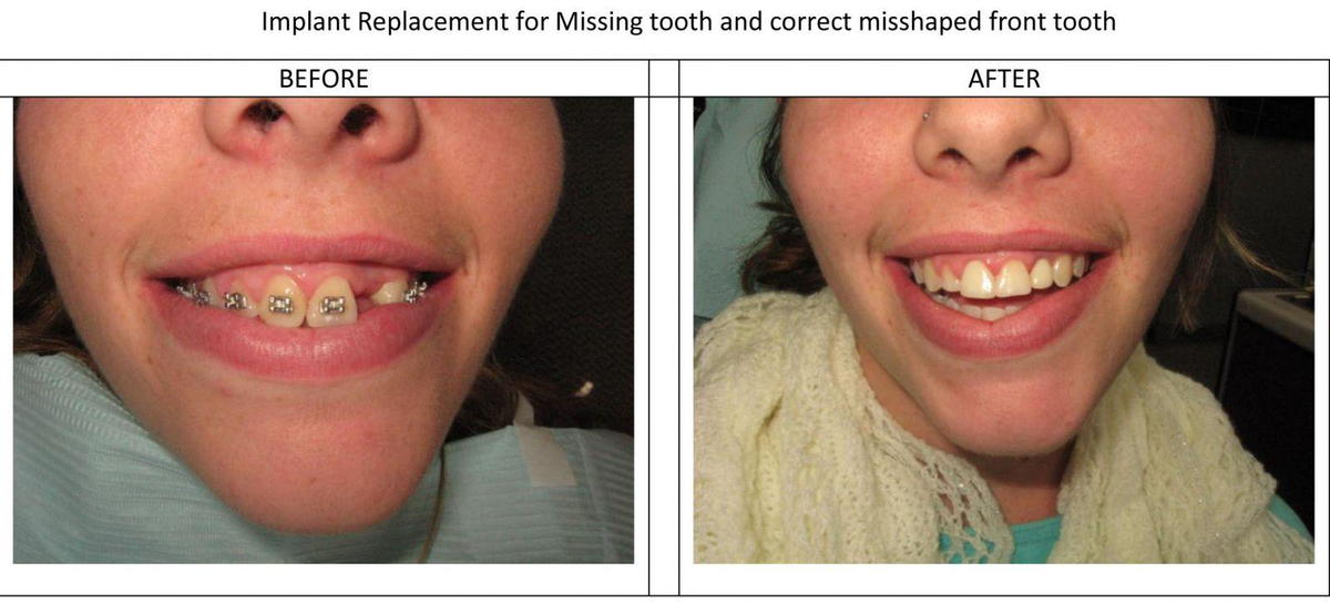 Implant replacement for missing teeth