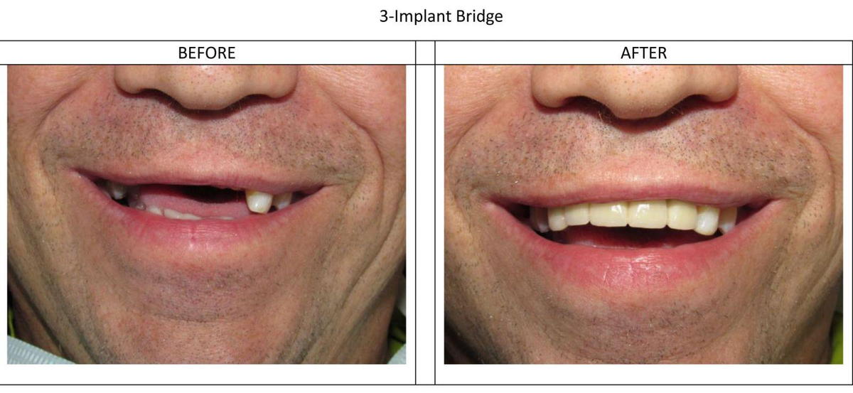 Dental Implant Bridge