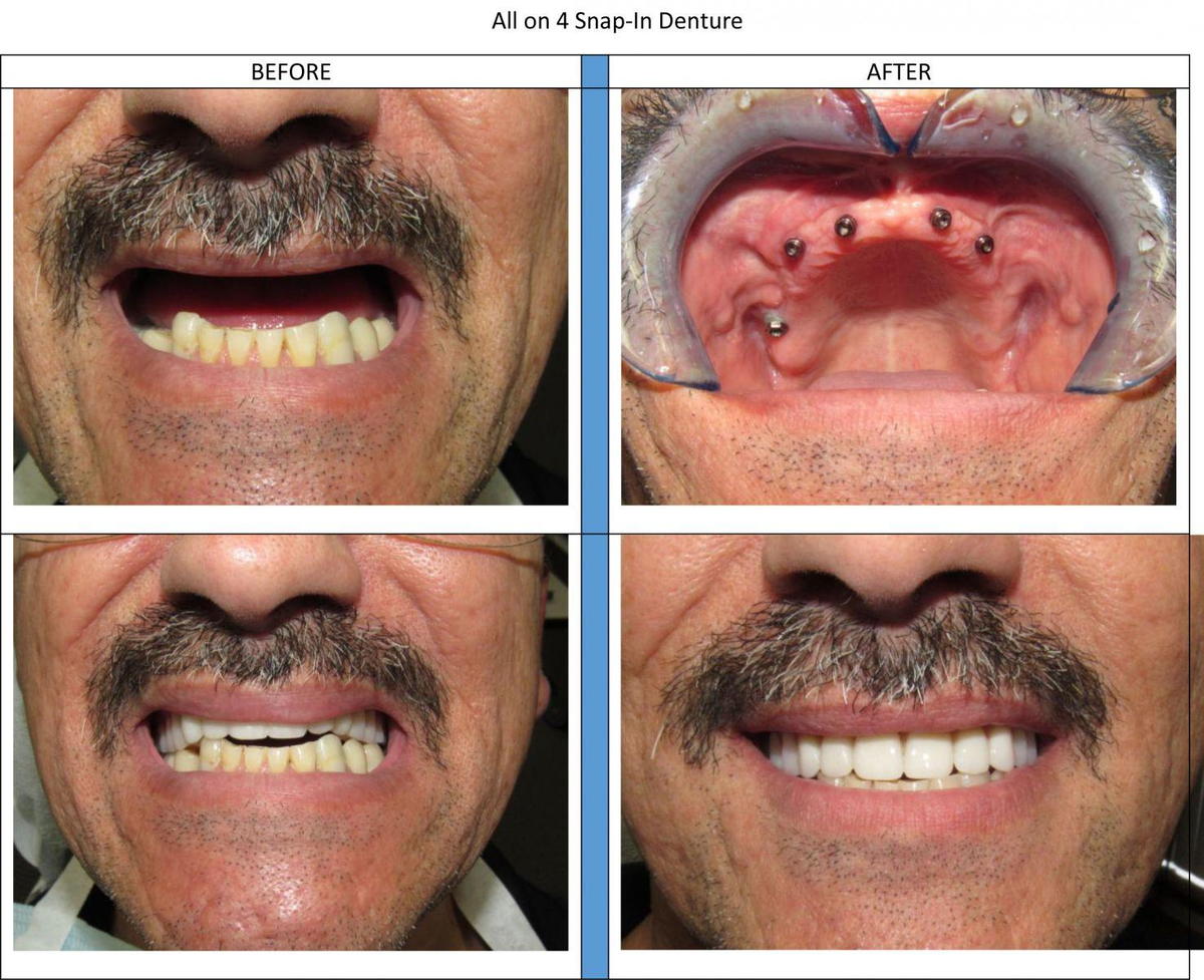 Implant Denture