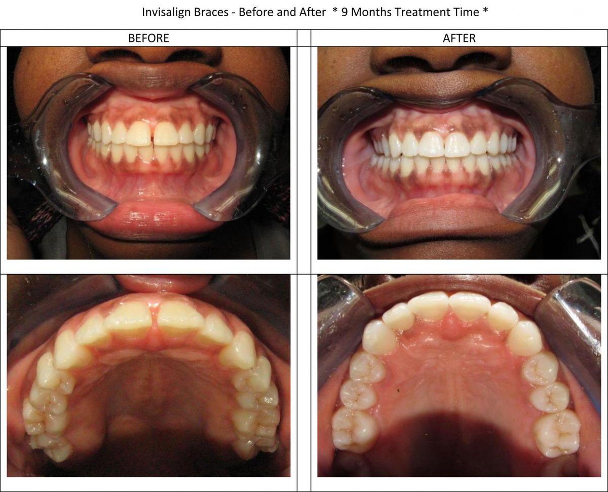 Invisalign Treatment completed in 9 months
