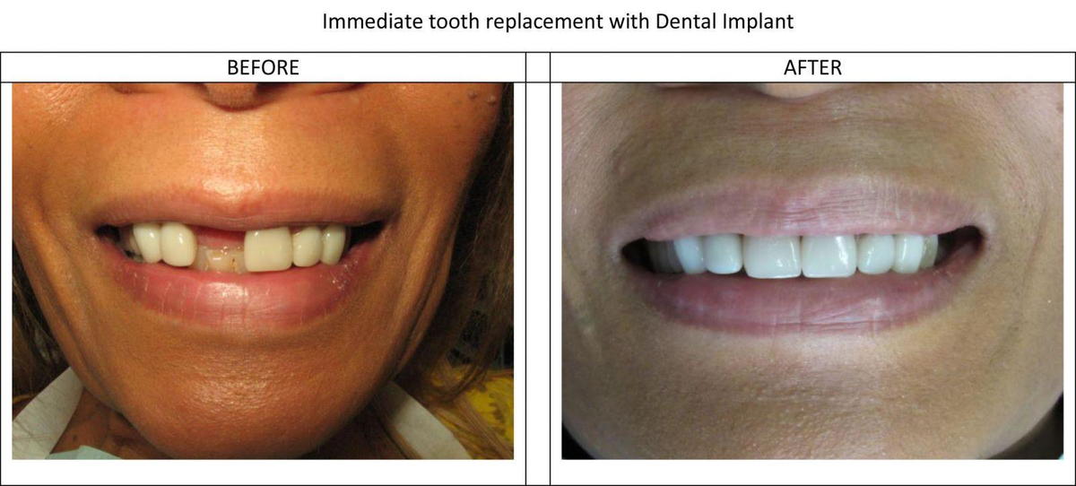 Immediate Placement Dental Implant 8