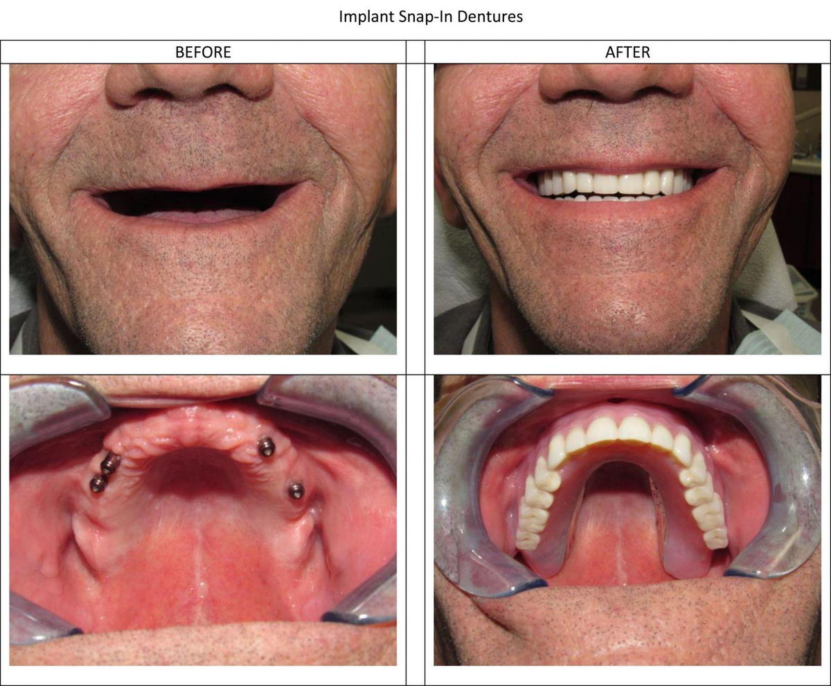 Implant Snap-In Dentures