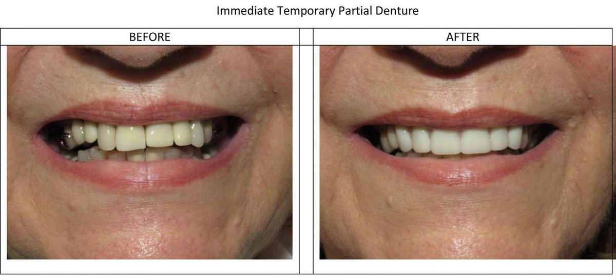 Immediate Partial Denture