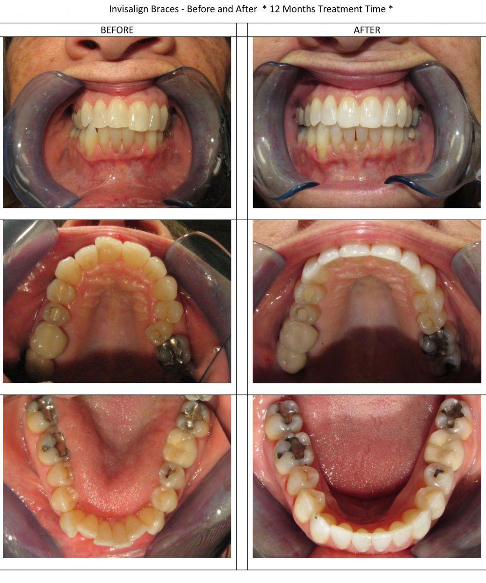 Invisalign Treament completed in 12 months
