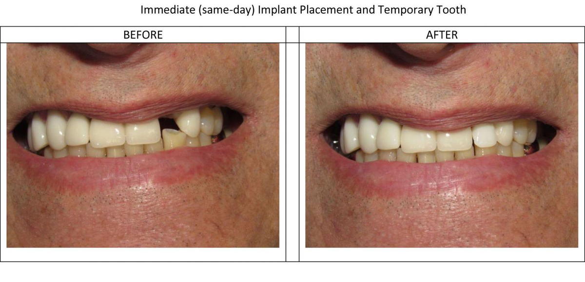 Immediate Placement Implant #10