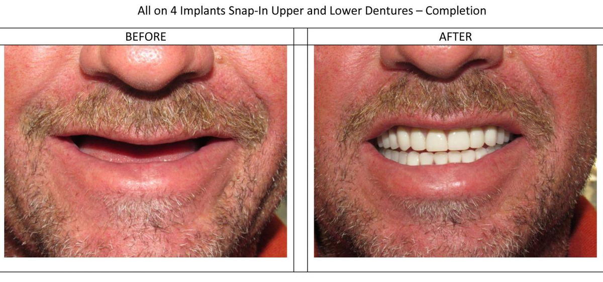 All on 4 Implants Snap-in upper and lower Dentures