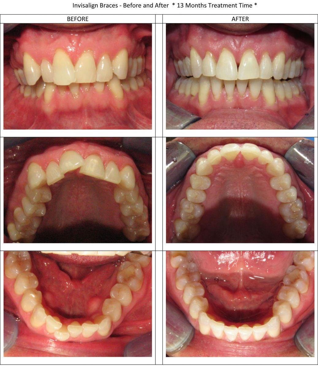 Invisalign Complete in 13 mos
