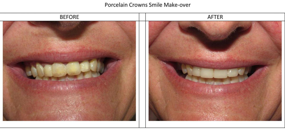 Dr Vanover Smile Makeover - Porcelain Crowns