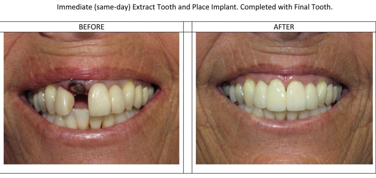 Immediate Placed Dental Implant with Final Crown