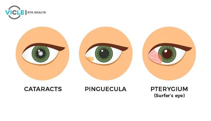 eye problems, cataracts, pinguecula, pterygium surfer's eye