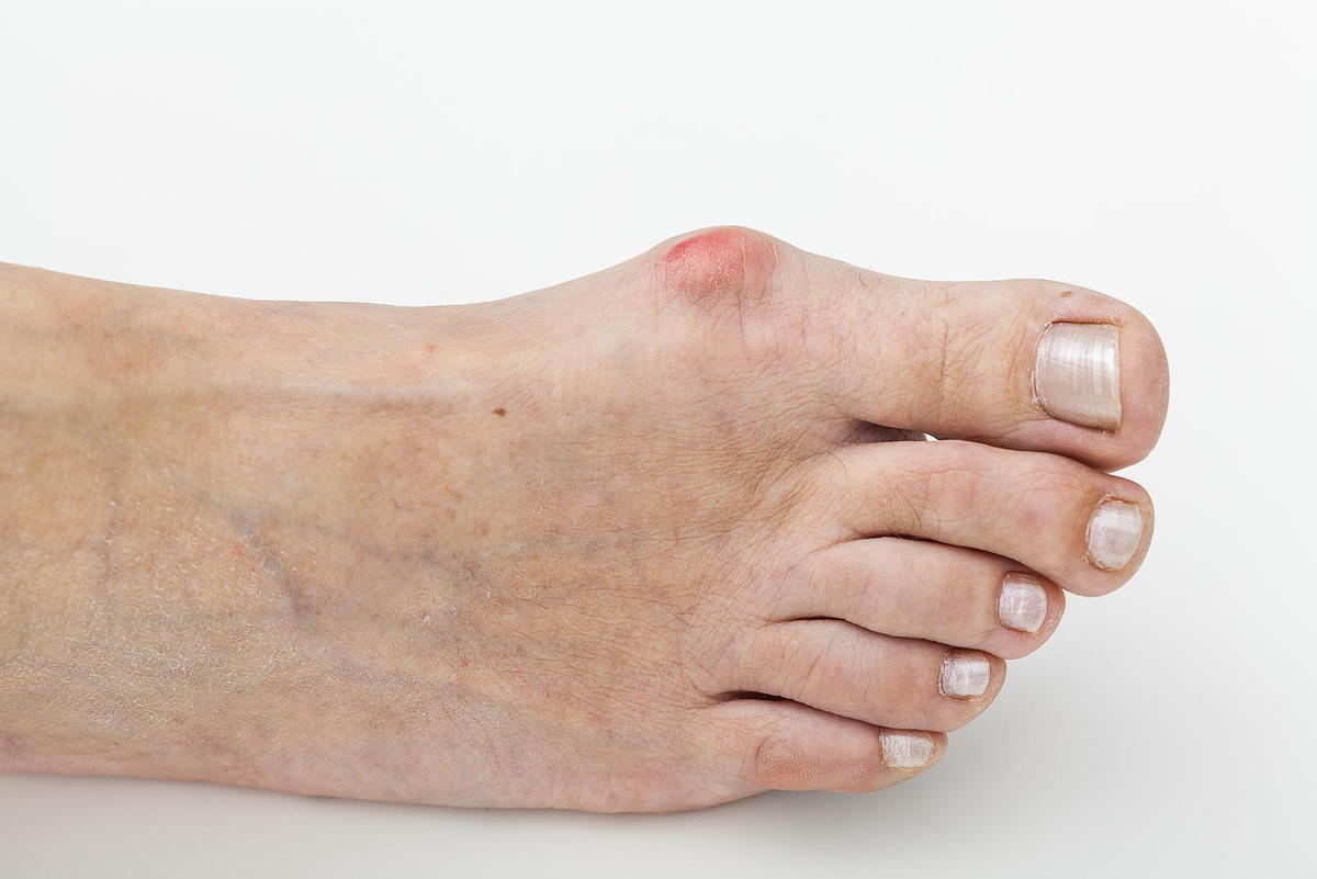 Are Your Shoes Causing You Ingrown Toenail Pain?