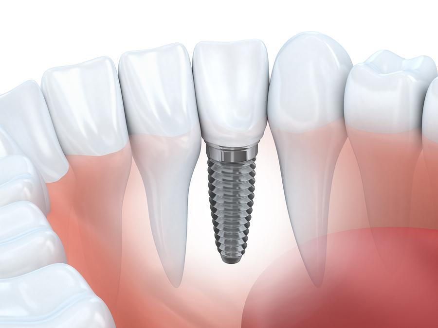 Dental-Implants