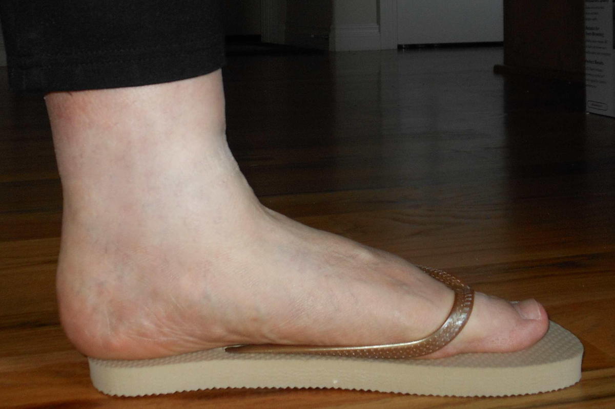 flip flops for pronated feet