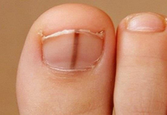 A DARK LINE UNDER YOUR TOENAIL COULD INDICATE CANCER STATES PODIATRIST   0418301001570043357 