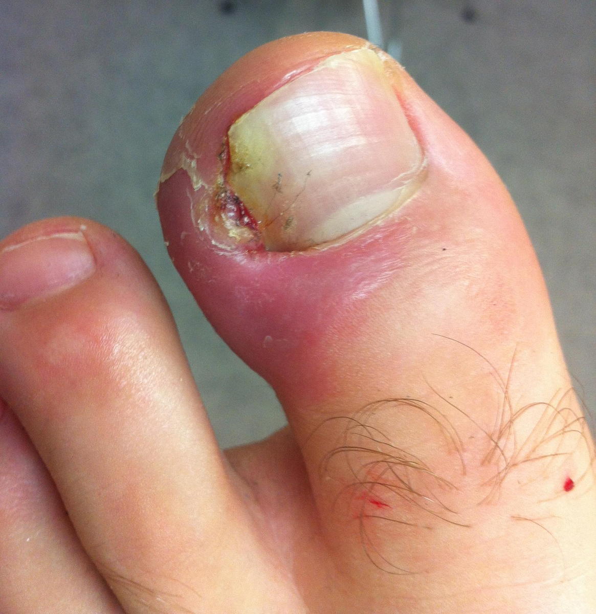 Ingrown Toenail Infection: Symptoms, Treatment, Causes