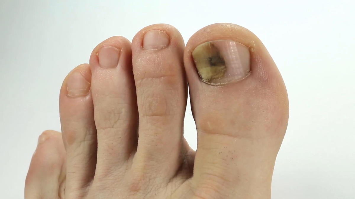 CANADIAN PODIATRIST STATES THAT DISCOLOURED NAILS CAN BE DUE TO MICRO ...