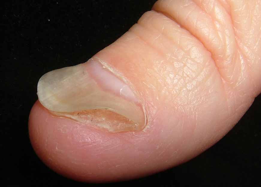 Top 10 reasons for brittle and deformed nails | TheHealthSite.com